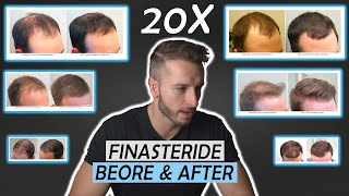 20 Finasteride Before And After Results NW1  NW5NW6 [upl. by Ainalem]