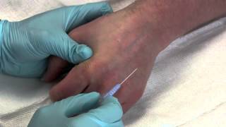 Intravenous Catheter Placement [upl. by Renelle]