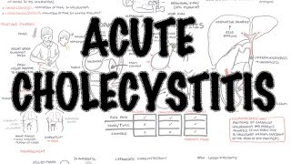 Acute Cholecystitis  Overview signs and symptoms pathophysiology treatment [upl. by Beitris]