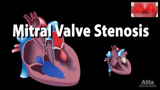 Mitral Valve Stenosis Animation [upl. by Nahtnaoj]