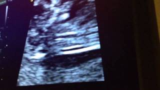 12 Week Ultrasound  Its a BOY [upl. by Stalk]