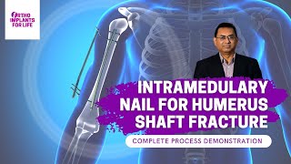 Intramedullary Nail For Humerus Shaft Fracture Procedure [upl. by Field135]