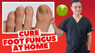 6 Effective HOME REMEDIES To CURE Toenail FUNGUS  Holistic Toenail Fungus Cures Part 2  Dr Kim [upl. by Ennayhs]