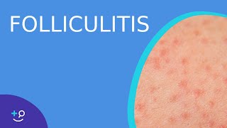 Folliculitis  Daily Dos of Dermatology [upl. by Sicard]