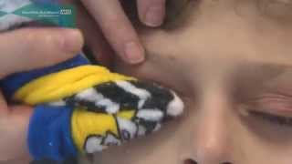 How to clean the eyelids in children and babies [upl. by Eiznekcm555]