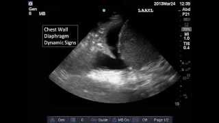 Cavitary Lung Lesion  Chest Xray Interpretation [upl. by Niraj]