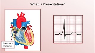 Advanced EKGs  WolffParkinsonWhite WPW Syndrome [upl. by Lemrahs940]