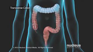 Colon Problems Diverticular Disease [upl. by Zulema]