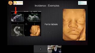 Ultrasound Diagnosis of Placenta Accreta A Tutorial for Imagers [upl. by Ostraw]