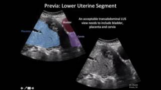 Ultrasound Diagnosis of Placenta Accreta A Tutorial for Imagers [upl. by Berwick264]