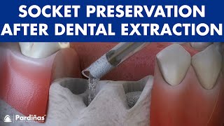 Tooth extraction  Treatment for socket preservation © [upl. by Dewie44]