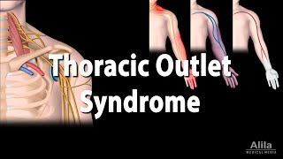 Thoracic Outlet Syndrome TOS Animation [upl. by Burley]