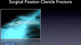 Treatment of Clavicle Fractures [upl. by Noret]