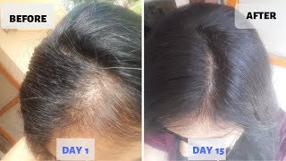 OMG  15 Days Hair Growth Miracle Treatment  Grow Long Thicken Hair  100 works [upl. by Snej785]