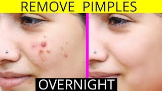 How To Remove Pimples Overnight  Acne Treatment  Anaysa [upl. by Leonhard788]