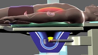 Shockwave Lithotripsy [upl. by Zolly]