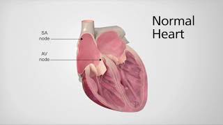 Normal Heart vs Heart in AFib [upl. by Fulks]