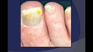 Toenail Debridement by a Podiatrist [upl. by Kemble40]