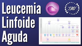 Leucemia Linfoide Aguda Explicada Claramente [upl. by Ham]