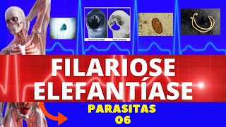 FILARIOSE  ELEFANTÍASE WUCHERERIA BANCROFTI  PARASITOLOGIA  INFECTOLOGIA [upl. by Annazus]