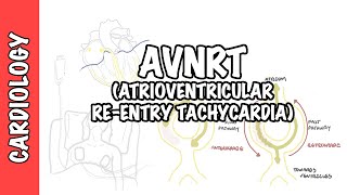 AVRNT atrioventricular reentry tachycardia  causes pathophysiology treatment [upl. by Tdnarb]