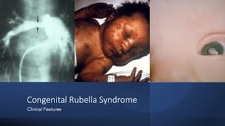 Measles rubeola Explained Clearly by MedCramcom  2 of 2 [upl. by Bertilla]