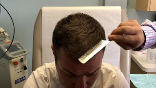 TOPICAL FINASTERIDE FOR MALE PATTERN HAIRLOSS  REAL PATIENT TESTIMONIAL [upl. by Derry]