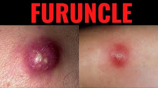 What is Furuncle Furuncle Boil DefinitionCauses Symptoms Risk Factors USMLE [upl. by Elenaj820]