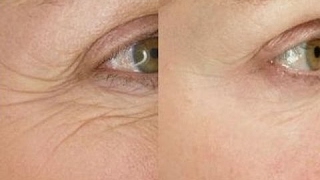 Smooth Eye Wrinkles With This Easy 5 Minute Face Massage [upl. by Noeled]