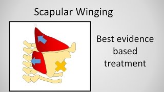 Scapular Winging Causes and Treatment [upl. by Fair]