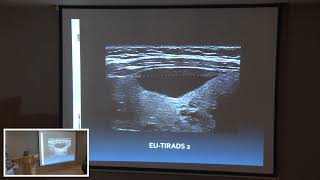 Echographie Thyroidienne Nouvelle Classification Dr JYacoubi [upl. by Annaierb430]