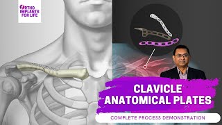 Clavicle Anatomical Plates Fixation Procedure [upl. by Asiul]