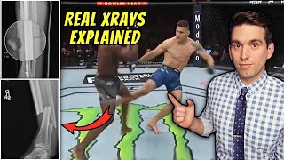 Chris Weidman Shares REAL Xrays of Broken Leg from UFC 261  Doctor Explains Images [upl. by Grega537]