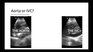 How to measure the AORTA Echocardiogram [upl. by Anuahsat917]