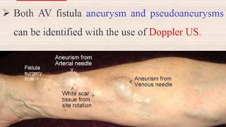 fistula Arteriovenous fistula AVF for Hemodialysis patients [upl. by Renferd866]