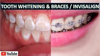 Professional Teeth Whitening With Braces amp Invisalign [upl. by Yleen41]