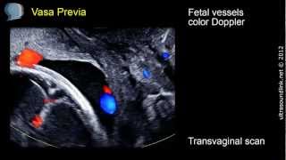 Vasa Previa  ultrasound diagnosis [upl. by Bunde]