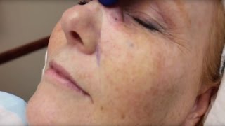 Dermabrasion Scar Removal Treatment [upl. by Jagir]