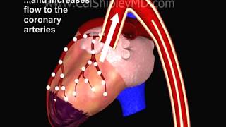 IntraAortic Balloon Pump Benefits and Risks [upl. by Grosz]