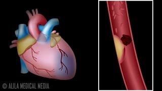 Myocardial Infarction and Coronary Angioplasty Treatment Animation [upl. by Saravat]