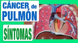 Cáncer de Pulmón  Síntomas [upl. by Warren]