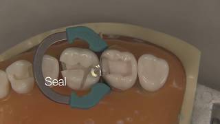 Class II Composite Restoration  Stevenson Dental Solutions [upl. by Lane]