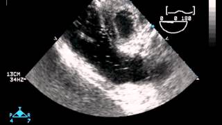 Transesophageal Echocardiography [upl. by Anelram]