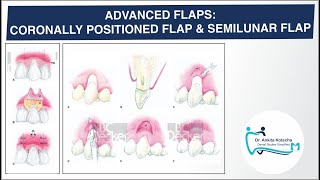 ADVANCED PEDICLE FLAPS CORONALLY POSITIONED FLAP SEMILUNAR FLAP ROOT COVERAGE DR ANKITA [upl. by Nomit]