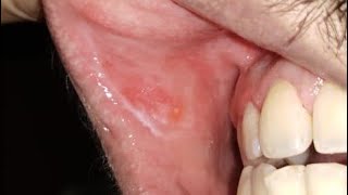 What causes green discoloration of tongue  Dr Shobith R Shetty [upl. by Englebert14]