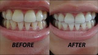 Crest 3D Whitestrips Vivid Before amp After Demo  Review [upl. by Corenda]