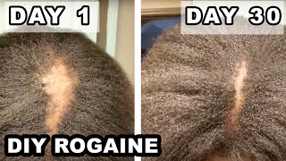 How I fixed my BALD SPOT  DIY Rogaine on 4C Natural Hair [upl. by Ssegrub450]