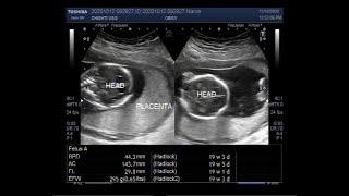 Ultrasound Video showing a Pregnancy of 25 weeks with partial placenta previa [upl. by Brittan]