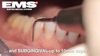 Piezon Instrument PS sub and supragingival scaling amp root debridement [upl. by Yot]