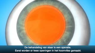 Staaroperatie cataract  OLVG Oogheelkunde [upl. by Iew]